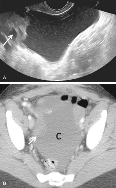 FIG 29-29, Peritoneal inclusion cyst. A, The right ovary ( arrow ) is noted along the superior wall of the cyst ( calipers ). Low-level echoes are present in the cyst fluid. B, Contrast-enhanced axial computed tomography shows the right ovary ( arrow ) along the cyst wall. The shape of the cyst (c) conforms to adjacent pelvic structures. The patient had previously undergone hysterectomy for leiomyomas.
