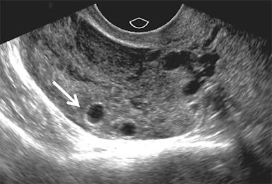FIG 29-3, Follicular ring sign in a patient with ovarian torsion. Transvaginal scan demonstrates an enlarged, edematous ovary with peripherally displaced small follicles, several of which have thin echogenic walls ( arrow ).