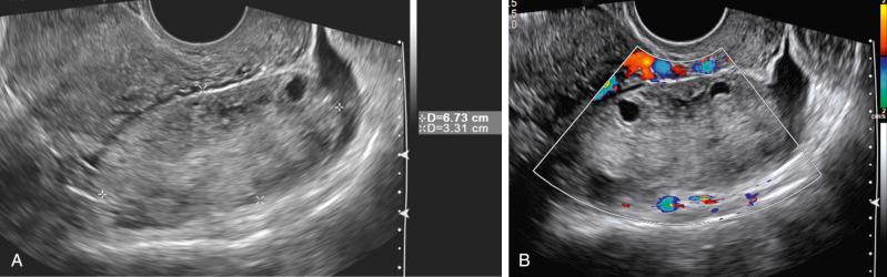 FIG 29-4, Ovarian torsion with infarcted necrotic ovary. A, Transvaginal scan demonstrates an enlarged ovary ( calipers ) with heterogeneous echotexture and a small amount of adjacent free fluid. B, Color Doppler image, optimized with “low flow” settings, demonstrates no flow to the ovary. Note thin echogenic walls of the anterior peripherally displaced follicles, the follicular ring sign. At surgery, the ovary and tube were twisted three times and appeared necrotic. Pathologic examination confirmed hemorrhage, congestion, and infarction of the ovary and fallopian tube.