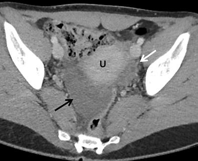 FIG 29-5, Computed tomography (CT) findings in ovarian torsion with no associated mass. Ovarian torsion in a patient evaluated with contrast-enhanced CT for possible appendicitis. The appendix was normal (not shown); however, the right ovary is enlarged ( black arrow ) and is located posterior to the uterus (U). The left ovary is normal size ( white arrow ) and normally located. Torsion with viable ovary was found at surgery.