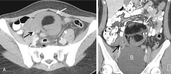 FIG 29-6, Computed tomography (CT) findings in ovarian torsion associated with mature cystic teratoma. A, Axial contrast-enhanced CT image demonstrates large fat-containing mass ( white arrow ) located anteriorly in the midline of the upper pelvis. Note twisted vascular pedicle ( black arrow ). B, Coronal reformatted image shows the large mature cystic teratoma ( white arrow ), containing fat and calcifications, in the midline superior to the bladder (B) and the twisted vascular pedicle ( black arrow ).