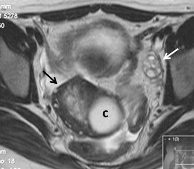 FIG 29-7, Magnetic resonance imaging findings in ovarian torsion with associated serous cystadenoma. Axial T2-weighted image shows enlarged right ovary ( black arrow ), located in the cul-de-sac at the posterior midline, with T2-weighted hyperintense cyst (c). The ovarian stroma demonstrates heterogeneous signal intensity due to hemorrhage and edema, and there are multiple small peripheral follicles. The left ovary ( white arrow ) is normal in size and appearance.