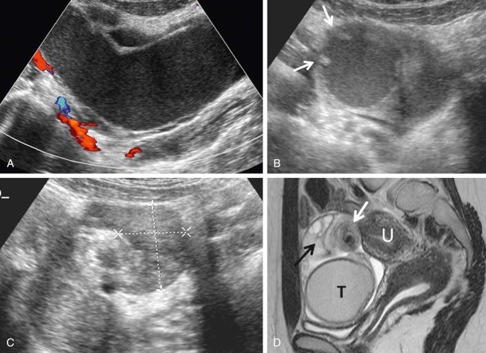 FIG 29-8, Isolated fallopian tube torsion. A, Color Doppler image shows tubular structure filled with complex fluid and no blood flow, corresponding to hematosalpinx. B, On cross section, the endosalpingeal folds ( arrows ) are visualized. C, The left ovary ( calipers ) was normal in size and echotexture and had normal blood flow (not shown). D, Sagittal T2-weighted magnetic resonance image shows the site of the twist ( white arrow ), the normal left ovary ( black arrow ), and the blood-filled dilated fallopian tube (T) anterior to the uterus (U).