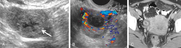 FIG 29-9, Spectrum of appearances of the corpus luteum. A, Cyst with thickened, crenulated wall ( arrow and calipers ). B, Typical “ring of fire” appearance on color Doppler sonogram. C, Typical appearance of corpus luteum ( arrow ) in the right ovary at contrast-enhanced computed tomography. Note enhancement of the wall of the corpus luteum.