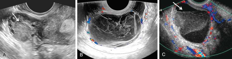 FIG 29-10, Sonographic spectrum of hemorrhagic ovarian cysts. A, Acute hemorrhage may appear as a solid lesion ( arrow and calipers ) with homogeneous low-level echoes. B, Typical fishnet or lace-like appearance representing fibrin strands. No internal vascularity is demonstrated with color Doppler sonography although vascularity is noted in the wall of the cyst. C, Retractile clot ( arrow ) possibly mimicking a solid nodule but recognized as a clot due to straight margins, acute angles, and lack of internal blood flow. Blood flow is shown in the wall of the cyst.