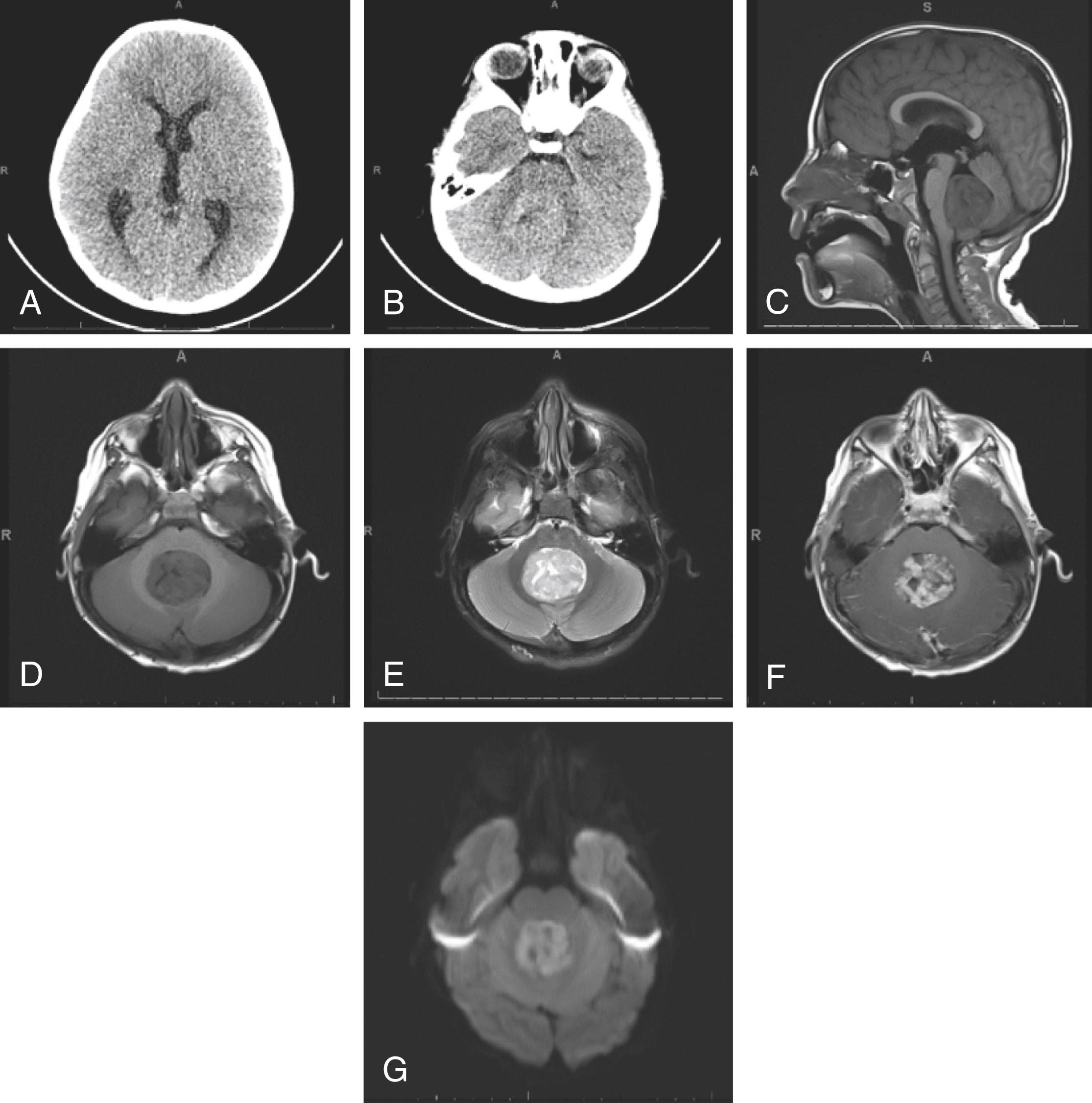 Fig. 7.1, (A) Axial CT head without contrast. Hydrocephalus involving lateral and third ventricles. (B) Axial CT head without contrast. Mildly hyperdense midline posterior fossa tumor with no definite calcifications. Tumor is expanding the fourth ventricle. 3.9 × 3.5 cm cross-section. (C) T1 sagittal MRI. T1 hypointense lesion centered in the fourth ventricle, appearing to arise from the inferior roof of the fourth ventricle, measuring 3.4 × 4.0 × 4.1 cm in AP, transverse, and craniocaudal dimensions, respectively. (D) T1 axial MRI. (E) T2 axial MRI. T2 mildly hyperintense (F) T1 axial FLAIR + contrast. The mass enhances heterogeneously. (G) Diffusion weight imaging (DWI). The mass demonstrates restricted diffusion, appearing white on DWI, suggesting increased cellularity. AP , Anterior-posterior; FLAIR , fluid attenuated inversion recovery.