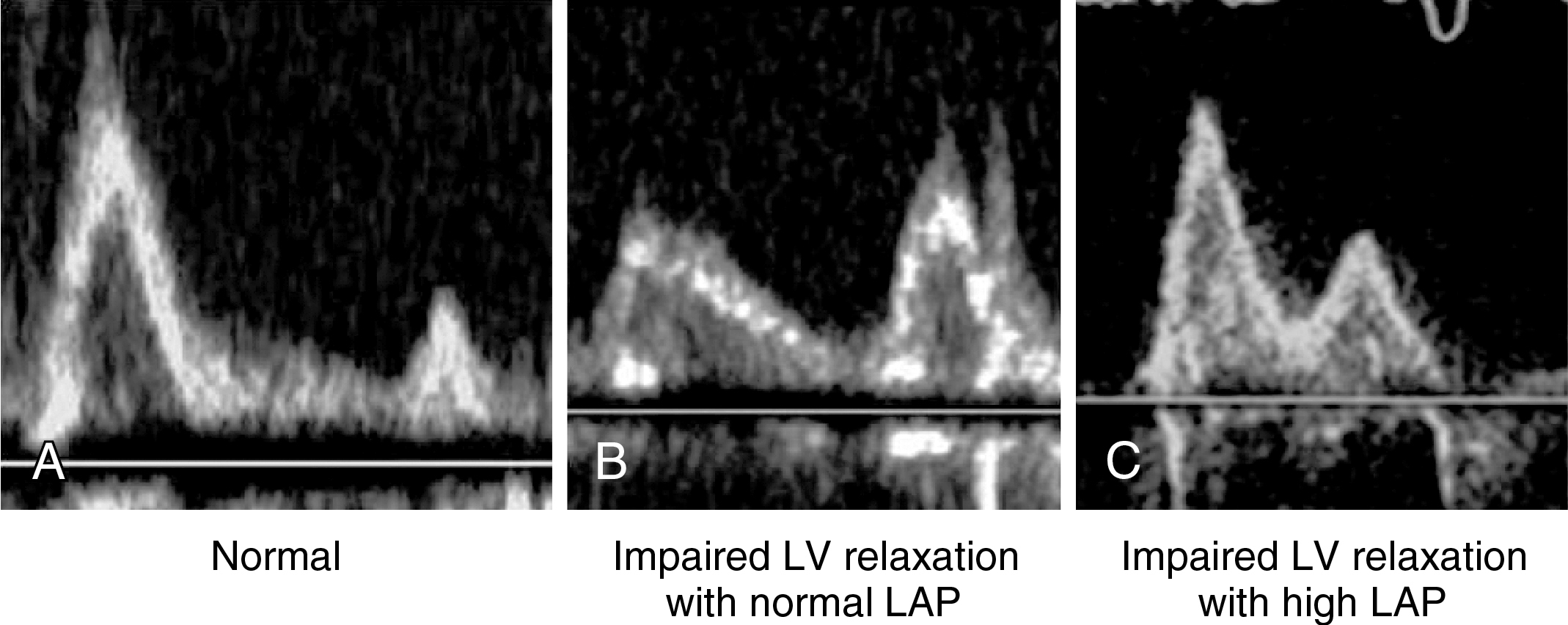 Figure 32-1, Mitral flow recorded with pulsed wave Doppler. A, Normal pattern; B, Impairment of left ventricular (LV) relaxation with normal left atrial pressure (LAP); C, Impairment of LV relaxation with high LAP.