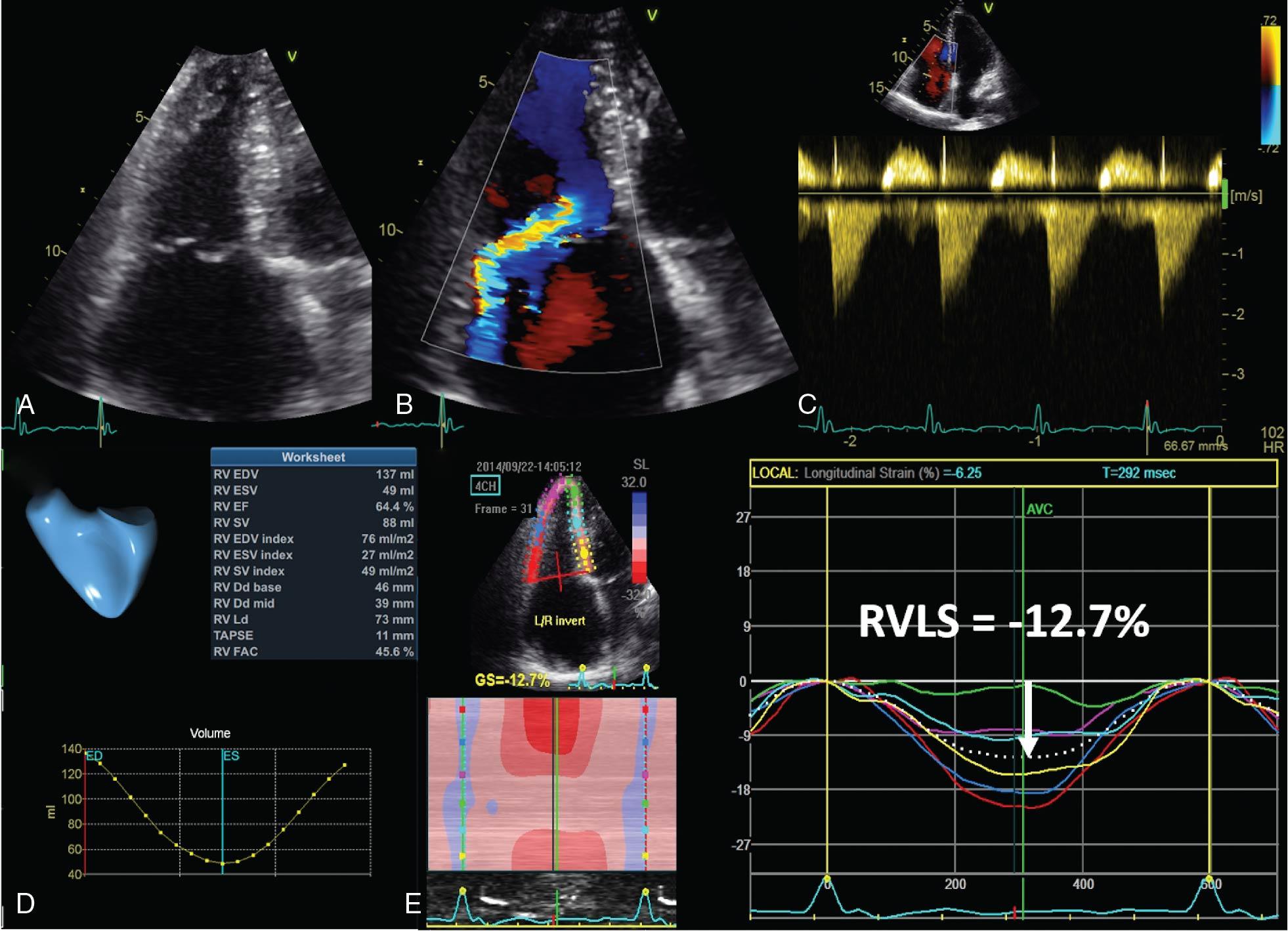 Fig. 9.4, Assessment of right ventricular (RV) function in severe organic tricuspid regurgitation ( B , C ). The right ventricle is dilated ( A , D ) with preserved ejection fraction ( D ). However, despite the volume overload, the RV four-chamber longitudinal strain is significantly reduced, identifying the occult RV systolic dysfunction. RVLS , Right ventricular longitudinal strain.