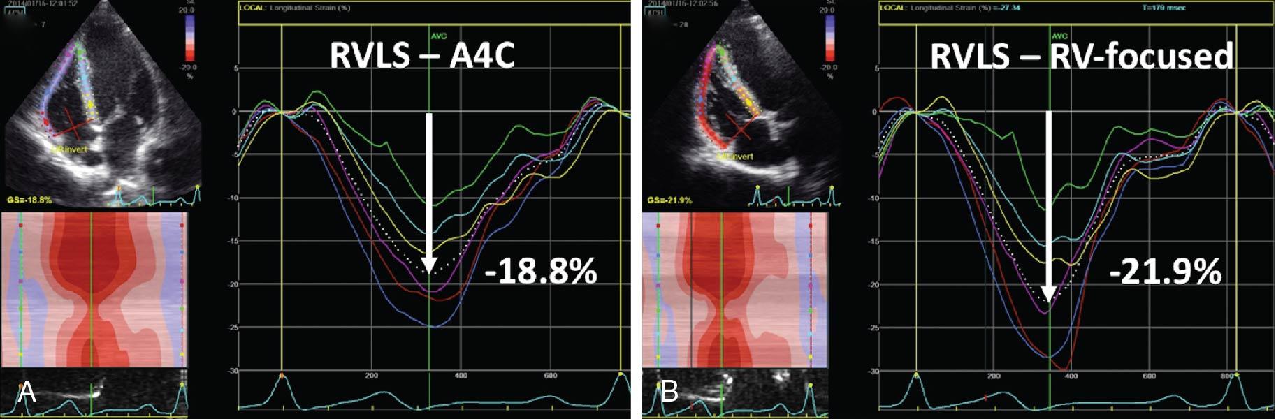 Fig. 9.5, Comparison of right ventricular (RV) four-chamber longitudinal strain obtained from a conventional apical four-chamber view (A4C; A ) and a RV focused four-chamber view ( B ) in the same patient. The RV-focused four-chamber view displays the whole free wall of the right ventricle and provides higher values of strain.