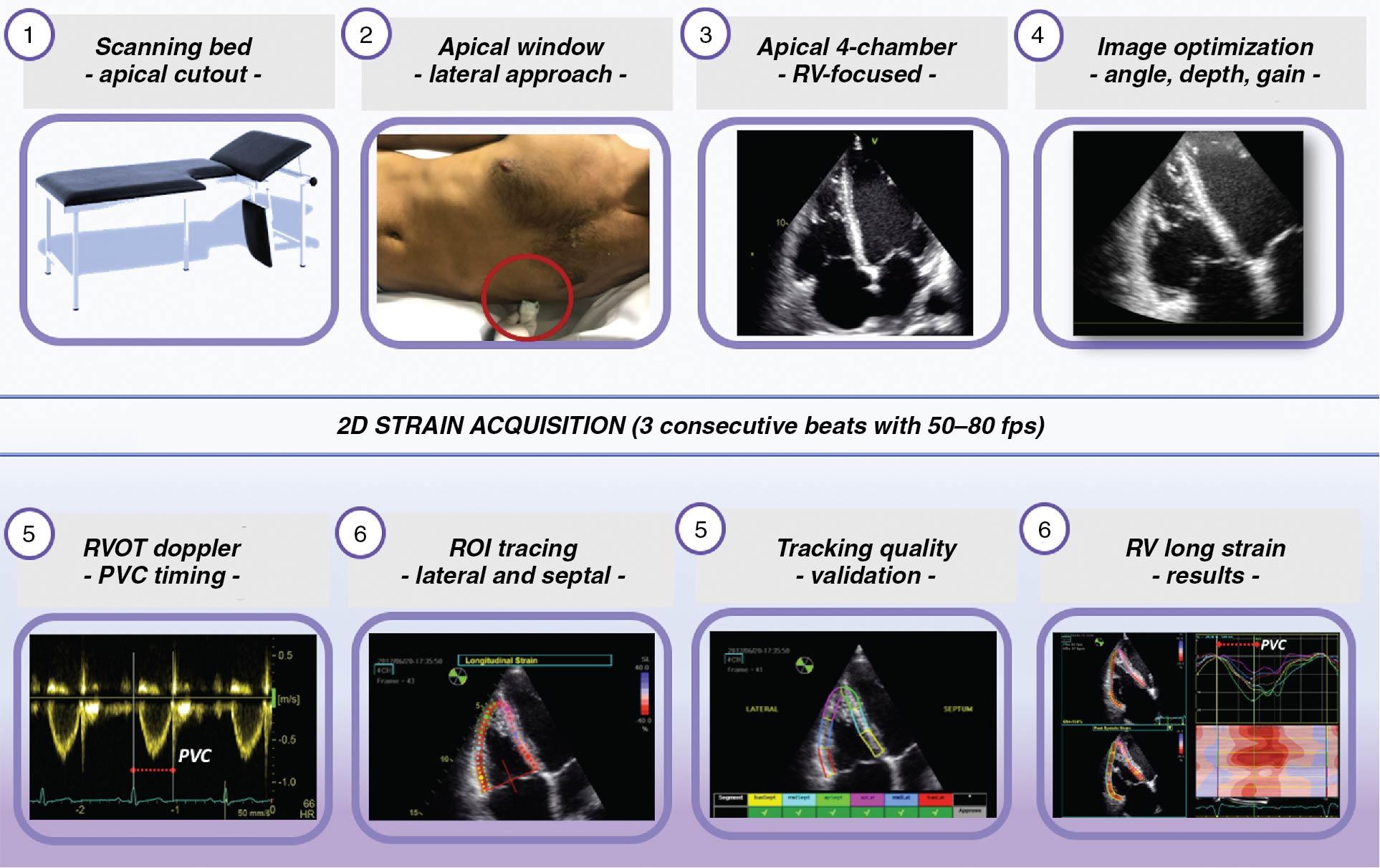 Fig. 9.6, Imaging protocol to measure right ventricular (RV) strain using speckle-tracking echocardiography. The use of a dedicated scanning bed with lateral cutout at the level of the apex of the heart allows a comfortable position of the patient and proper position and orientation of the probe. To obtain a RV focused four-chamber view, the probe is positioned more laterally than when obtaining the conventional four-chamber view and more directed toward the right shoulder. When the proper view is obtained, gain, contrast, and depth should be optimized to record the images with a temporal resolution of 50 to 80 fps. The pulsed-wave Doppler tracing recorded in the RV outflow tract allows the precise definition of the beginning and the end of the RV ejection time. The region of interest should include both the RV free wall and septum, and its width should be adjusted to cover the thickness of RV free wall (∼5 mm in normal subjects and larger in the presence of RV hypertrophy). After having checked the quality of the tracking and its final approval by the operator, regional strain values are displayed. RV free-wall longitudinal strain (RVFWLS) is the average of the strain values of the three segments of the RV free wall. RV four-chamber longitudinal strain (RV4CLS) is the average of the strain values of the six segments of the RV free wall and interventricular septum. PVC, Pulmonary valve closure time; ROI, region of interest.