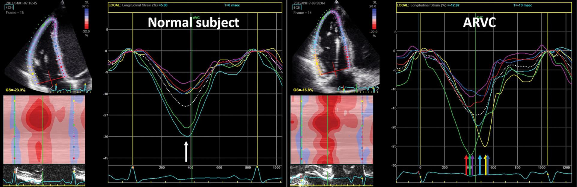 Fig. 9.7, Assessment of right ventricular (RV) dyssynchrony. In a normal subject (left panel) all six RV segments reach the peak strain at the same time (white arrow) . In a patient with genetically proven arrhythmogenic RV cardiomyopathy (ARVC, right panel) , the time from the R wave on the electrocardiogram (ECG) to peak segmental strain is highly variable (colored arrows). The standard deviation of times to peak segmental strain represents the dyssynchrony index.