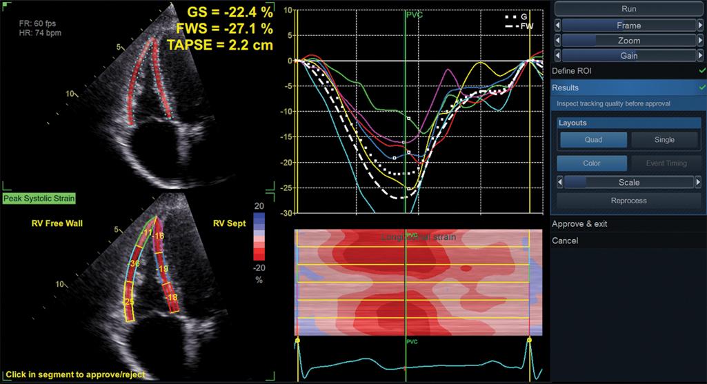 Fig. 9.9, Right ventricular (RV) strain software package to measure RV strain (EchoPAC, GE Vingmed, Horten, Norway). The algorithm tracks the motion of the speckles within the RV myocardium on subsequent frames throughout the cardiac cycle and provides the peak strain values for the six segments (left panels). In addition, it automatically calculates the RV four-chamber (global strain [GS], dotted line in the right upper panel ) and free-wall strain (FWS, dashed line in the right upper panel ), as well as tricuspid annular plane systolic excursion (TAPSE). The time course of the longitudinal strain of each RV segment is shown as time-strain curves (upper right panel) or anatomic M-mode parametric curves (lower right panel). The colors are used to identify the RV myocardial segments.