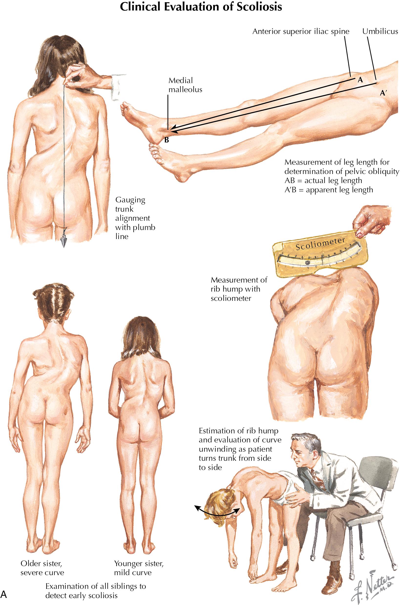 Fig. 6.1, (A) Clinical evaluation of scoliosis. (B) Thoracic scoliosis. (C) Thoracic and lumbar scoliosis.