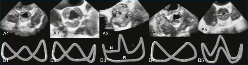 Figure 4-1, The varying shape of the aortic valve annulus reconstructed from real-time three-dimensional transesophageal echocardiography data. A1, normal trileaflet valve; A2, calcified tricuspid valve; A3, scalene tricuspid valve; A4, bicuspid aortic valve, and A5, quadricuspid aortic valve.