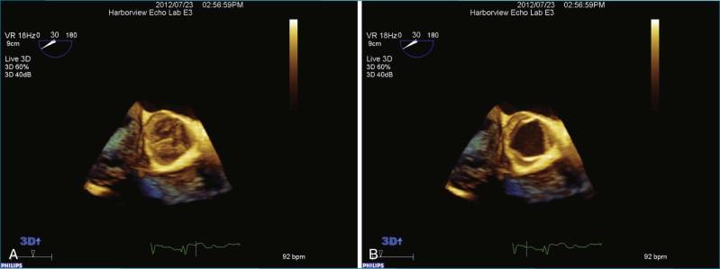 Figure 4-2, The center nodule of Arantius is prominent in this real-time three-dimensional transesophageal echocardiography short-axis view of the aortic valve.