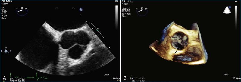 Figure 4-3, A, Short-axis two-dimensional transesophageal echocardiography (TEE) of normal aortic valve. B, Short-axis real-time three-dimensional (3D) TEE of a normal aortic valve. This case shows an advantage and disadvantage of real-time 3D echocardiography. The advantage is the ability to see the body of the aortic valve cusp. The disadvantage is that there is some dropout ( arrow ) of the leaflet rather than an actual hole in the leaflet. This problem is encountered more with the semilunar valves than the atrioventricular valves because the former are thinner.