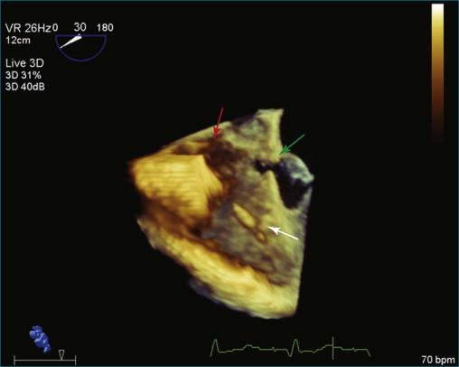 Figure 4-4, Gerbode defect. Clockwise from top , Right atrium ( red arrow ), interatrial septum, defect in right coronary sinus of Valsalva ( green arrow ), mitral valve, and right ventricle with pacemaker ( white arrow ) (see Video 4-1).