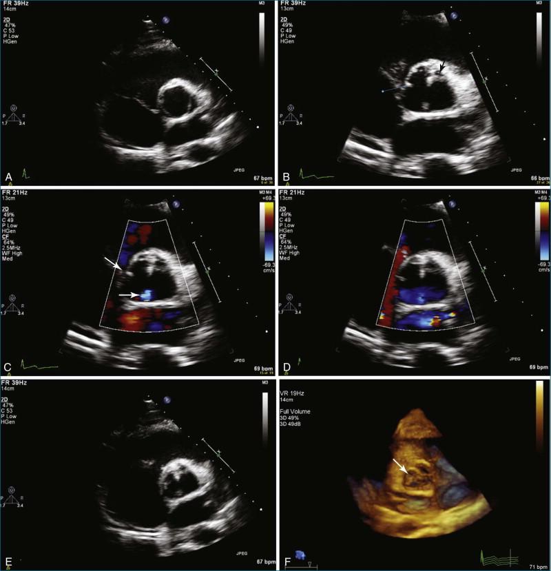 Figure 4-5, These figures are from the same patient and demonstrate two-dimensional (2D) and real-time (RT) three-dimensional (3D) echocardiography images of a bicuspid aortic valve. A, Bicuspid aortic valve by 2D transthoracic echocardiography (TTE) parasternal short-axis view. In this view, the valve has the typical “fish mouth” bicuspid look, and no raphe is clearly visible. B, 2DTTE parasternal short-axis view. In this image, the main closure of the bicuspid valve is shown from the 12:30 to 6:30 o'clock positions ( arrow ). There is also a small raphe shown at the 9:00 o'clock position, in the area where the right and noncoronary cusp would fuse if this were a trileaflet valve. C, 2DTTE, parasternal short-axis view. In this image, a small amount of aortic regurgitation is shown ( red arrow ). The raphe shown in B is seen again ( white arrow ). D, Image of the aortic regurgitation and the raphe shown in C (see Video 4-2). E, 2DTTE parasternal short axis view. The raphe seen in C is again seen, as well as the closure line of the bicuspid valve at the 1:00 and 6:30 o'clock positions (see Video 4-3). F, RT3D transesophageal echocardiography (TEE) image of the bicuspid aortic valve closed. The raphe seen by 2D in C is shown in 3D here. This emphasizes how the raphe is more complex and longer than appreciated by the 2D image. G, RT3DTTE image showing that there are two raphes, one at approximately the 11:00 o'clock position and one at the 5:00 o'clock position. Again, the anatomy of the raphes is appreciated better than in 2D (see Video 4-4). H, 2DTEE image of the bicuspid aortic valve taken at an angle of 33 degrees. Note that with the aortic valve completely open in mid-systole, the raphes are not seen. I, 2DTEE image of the bicuspid aortic valve. Note the aortic regurgitation; the orientation of the valve is now opposite the transthoracic orientation, with the posterior at the top of the image. Note the complex raphe near the anterior opening of the valve ( arrow ). J, RT3DTEE of the bicuspid aortic valve. Note the additional raphes seen with RT3DE that were not seen in the 2DTEE images ( arrow ). K, 2DTEE of the bicuspid aortic valve. Note the raphes present, but the lack of perception of depth in the 2D image (see Video 4-5). L, RT3DTEE of the bicuspid aortic valve. Note the “fish mouth” appearance of the aortic valve opening as well as the depth perception of the aortic valve leaflets. M, RT3DTEE of the bicuspid aortic valve. As opposed to L, the valve is more open as it is captured in mid-systole. Note that this is frame 9 of the cardiac cycle. N, RT3DTEE showing raphe formation at the 9:00 and 6:00 o'clock positions in this bicuspid aortic valve (see Videos 4-6 and 4-7). O, RT3DTEE of the bicuspid aortic valve taken from the opposite side of the valve. In this case, the image is taken from the aortic side of the valve (see Video 4-8). P, RT3DTEE with the transducer at 35 degrees shows the closed bicuspid valve with raphes present at the 9:00 and 6:00 o'clock positions and thickening of the tissue associated with the raphe.