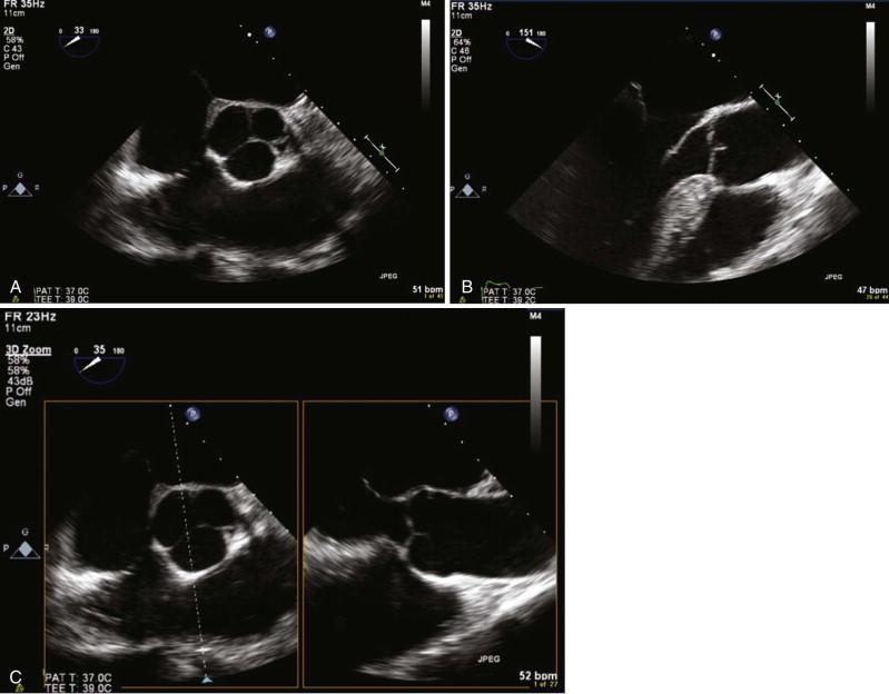 Figure 4-6, Two-dimensional (2D) transesophageal echocardiography (TEE) views of the aortic valve. A, Short-axis view of the aortic valve by RT3DTEE with the transducer at 35 degrees. B, Long-axis view of the aortic valve with the transducer at 150 degrees (see Videos 4-9 and 4-10). C, The setup for going to RT3DTEE in the 3D zoom mode. Image of the biplane, or “X-plane,” view is shown at left . Note that the aortic valve is shown simultaneously in orthogonal views (35 degrees and roughly 150 degrees) (see Video 4-11). D, RT3DTEE in the 3D zoom mode. D1, Short-axis view of the aortic valve (closed); D2, short-axis view of the aortic valve (open); D3, long-axis view of the aortic valve. Note the coronary artery shown coming off the sinus of Valsalva ( arrow ). E, RT3DTEE in the 3D zoom mode. E1, Short-axis view of the aortic valve (with right ventricular outflow tract more anterior and tricuspid valve); E2, short-axis view of the aortic valve (zoomed); E3, long-axis view of the aortic valve. Note the coronary artery shown coming off the sinus of Valsalva ( arrow ) (see Videos 4-12 to 4-14).