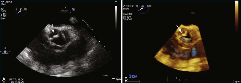 Figure 4-7, Aortic sclerosis shown by ( A ) two-dimensional (2D) transesophageal echocardiography (TEE) and ( B ) real-time three-dimensional (3D) TEE. In both cases, a short-axis view at an angle near 35 degrees is shown. There is particular sclerosis of the noncoronary cusp seen in both 2D and 3D ( arrows ). The extent of the sclerosis throughout the entire cusp is more readily apparent on the 3D image (see Videos 4-15 to 4-17).