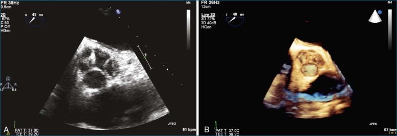 Figure 4-8, Quadricuspid valve. A, Two-dimensional transesophageal echocardiography (TEE) short-axis view of a quadricuspid valve. Note that the cusp at the 2 o'clock position is substantially smaller than the others. B, Real-time three-dimensional (RT3D) TEE short-axis view of the quadricuspid valve. The major difference and advantage appreciated in RT3DTEE is the ability to see the body of the aortic valve cusps. This also gives a more realistic perspective of the relative sizes of the cusps (see Videos 4-18 and 4-19).