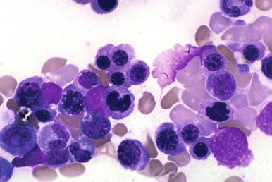 Figure 57-3, Post-therapy dyserythropoiesis associated with erythroid hyperplasia is common and should not be interpreted as myelodysplastic syndrome, which should exhibit dysplastic changes of other cell lines.