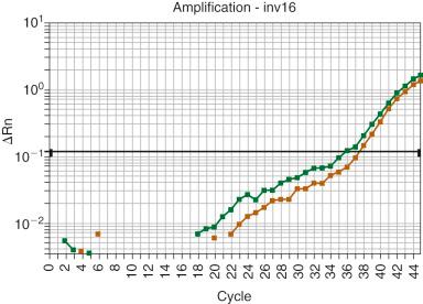 Figure 57-7, Real-time quantitative reverse transcriptase polymerase chain reaction (RT-PCR) for inv(16) detects a low level of the transcript following therapy for acute myeloid leukemia with inv(16) after normalization of the value against an internal control gene. This finding alone is not sufficient for a diagnosis of relapse because RT-PCR often continues to be positive for this abnormality at low levels, even in patients in remission. Follow-up samples showing an increase in the level of inv(16) would be needed before relapse could be suggested.