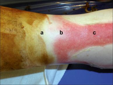 Fig. 10.1, Jackson's three zones of injury on an ankle burn: (A) the zone of coagulation; (B) the zone of stasis, and (C) the zone of hyperemia.