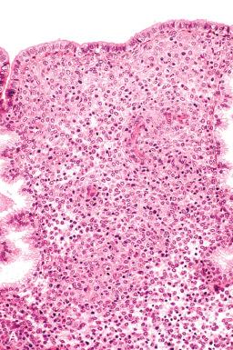 Fig. 16.11, A, Predecidua cuffing around spiral arterioles begins at day 23. B, Cytoplasmic basophilia and nuclear hypochromasia produce a loss of cell contrast.