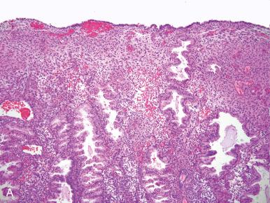 Fig. 16.12, A, Predecidua distributed on the surface by day 25 or 26. B, Extension of predecidua between glands occurs by day 27. C, Endometrial granulocytes emerge around day 26.