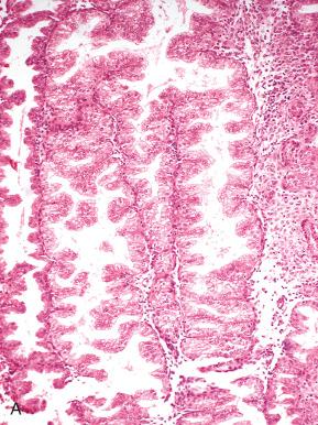 Fig. 16.13, A, Saw-toothed glandular configuration seen in late secretory endometrium. B, Small tubular glands may be present, simulating exogenous hormonal effect.