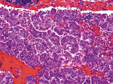 Fig. 16.4, A, Aggregated stromal breakdown and glands simulating endometrial carcinoma. B, Small fragments of endometrial carcinoma simulating menstrual endometrium.