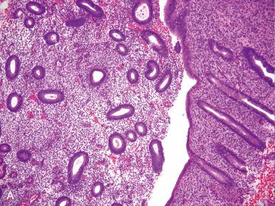 Fig. 16.6, A, Low-power microphotograph of proliferative endometrium illustrating abundant tubular glands. B, At higher power, the pseudostratified epithelium contains prominent nuclei with mitoses. C, Pseudopredecidual changes in a proliferative endometrium. D, Gland-in-gland (telescoping) artifact.