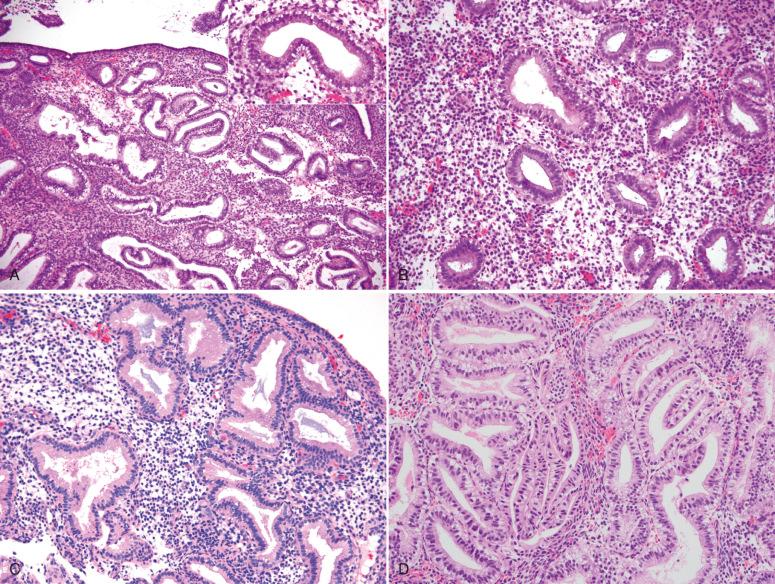 Fig. 16.8, A, Low power of day-17 secretory endometrium (compare with Fig. 16.5A ). Inset illustrates prominent subnuclear vacuoles. B, Secretory endometrium, day 18. C, Secretory endometrium, day 19. D, Artifactual crowding of glands in early secretory endometrium may simulate endometrial intraepithelial neoplasia (atypical hyperplasia).