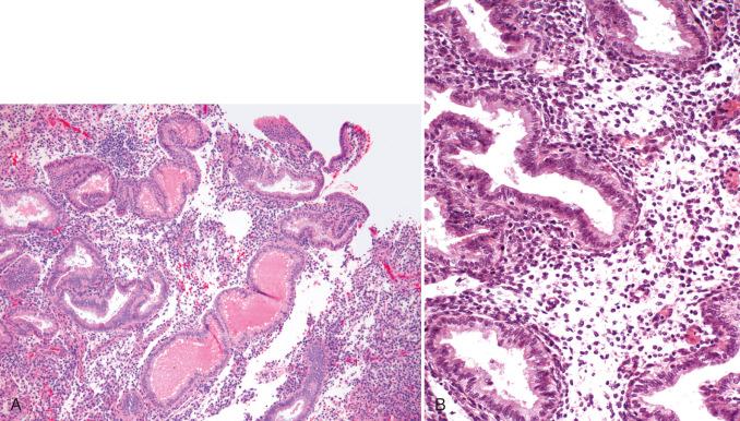 Fig. 16.9, A, Secretory endometrium, day 20. B, Day 21.