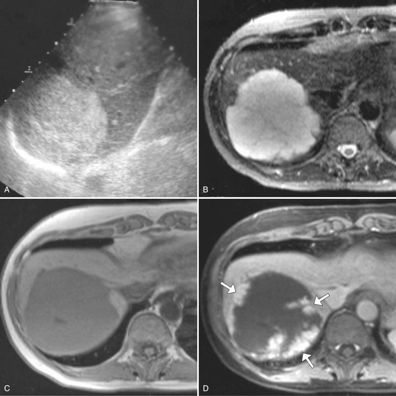 Fig. 11-1, Hemangioma.