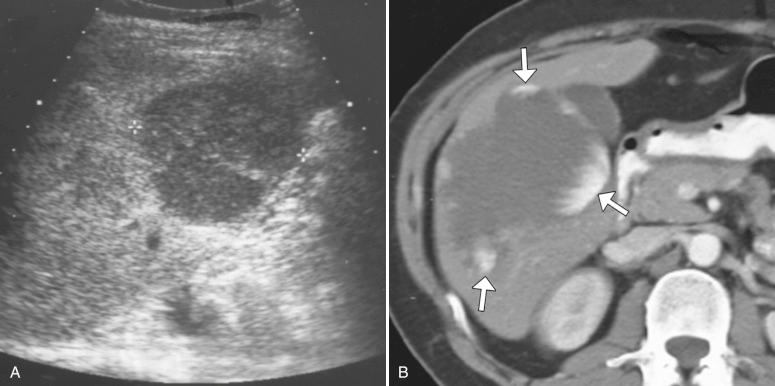 Fig. 11-2, Atypical hemangioma on ultrasonography.