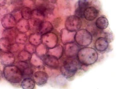 Figure 5-2, Nuclear grooves, chromatin clearing, margination and 3-dimensional effect in papillary thyroid carcinoma FNA. Millipore filter (Papanicolaou, ×HP).