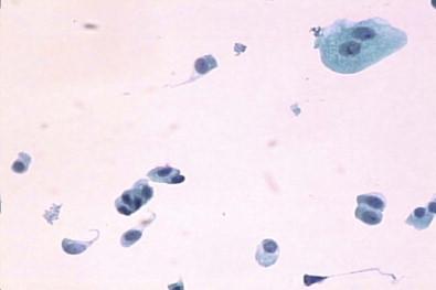 Figure 5-3, True monolayer of benign urothelial cells in clear background in voided urine. ThinPrep (Papanicolaou, ×MP).