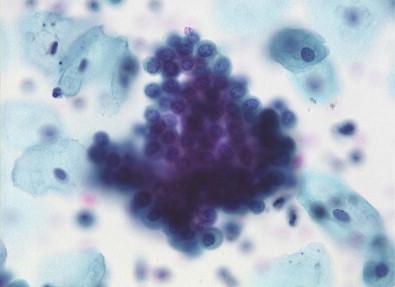 Figure 5-4, True tissue fragment of papillary urothelial carcinoma in voided urine. SurePath (Papanicolaou, ×MP).