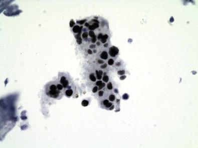 Figure 5-7, Metastatic lung adenocarcinoma in pleural fluid. Cell block (TTF1 immunostain positivity, ×MP).