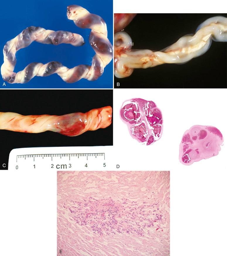 Fig. 31.11, A, Recent umbilical vessel thrombosis, seen as candy cane spiraling. B, Remote umbilical vessel thrombosis, seen as a linear white streak. C, Focal nodal swelling signifying recent rupture of the umbilical vein antedating demise. D, Cross section of C showing extensive dissecting hemorrhage around vessels (upper left) and into Wharton's jelly (lower right). E, Umbilical cord hemangioma. This is microscopic and presumably of no clinical significance.