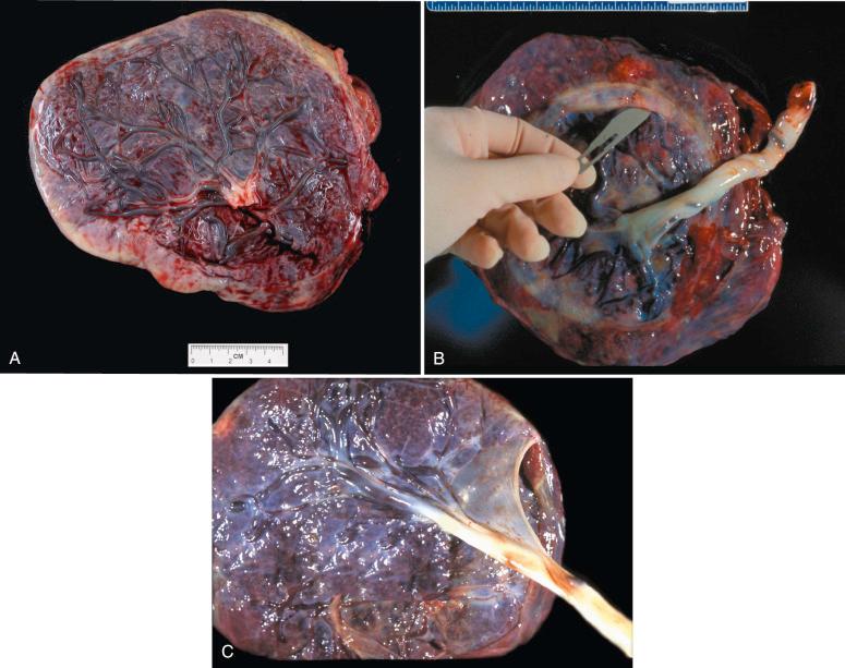 Fig. 31.12, A, Circummarginate membrane insertion. B, Circumvallate membrane insertion. C, Amnion web.