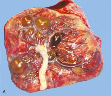 Fig. 31.13, A, Multiple subchorionic cysts. B, Subamniotic cyst.