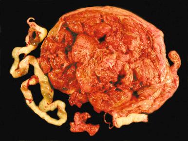 Fig. 31.17, Disrupted maternal surface. The inability to reconfigure the placenta, including its fragments, into a complete mosaic maternal surface raises concern for retained portions of placenta.