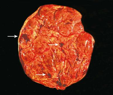 Fig. 31.18, Incidental retroplacental hemorrhage, present as small loosely adherent clots (arrows) on the maternal surface.