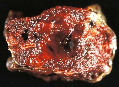 Fig. 31.23, Cross section of placental disc with fresh intervillous thrombus (center).