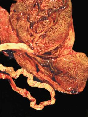 Fig. 31.4, Succenturiate lobe (lower right).