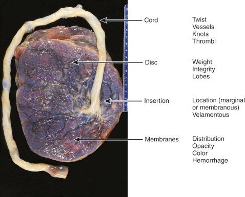 Fig. 31.5, Outline for inspecting the placental surface.