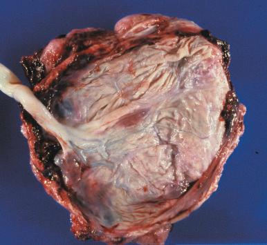 Fig. 31.6, White, nearly opaque fetal surface in acute chorioamnionitis.